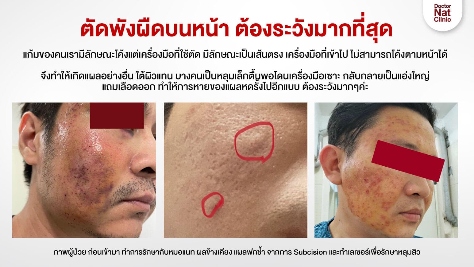 ตัดพังผืดบนหน้า ต้องระวัง