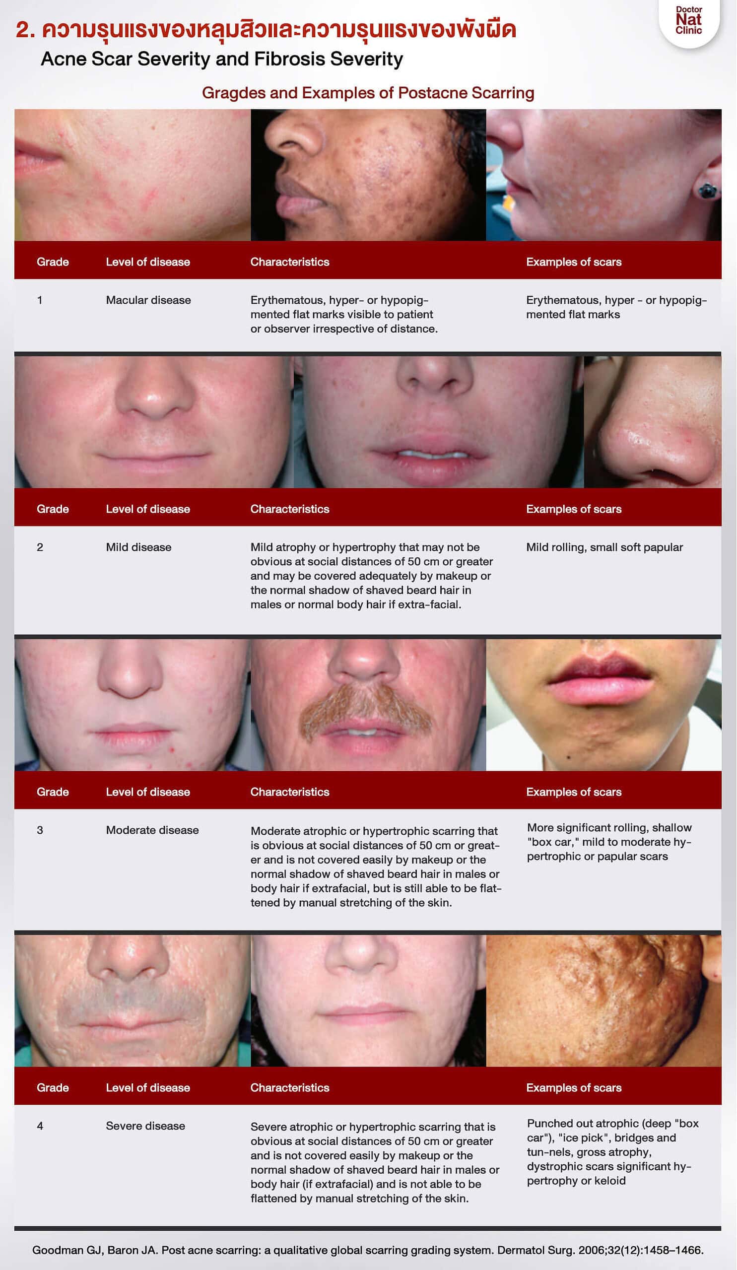 ความรุนแรงหลุมสิว