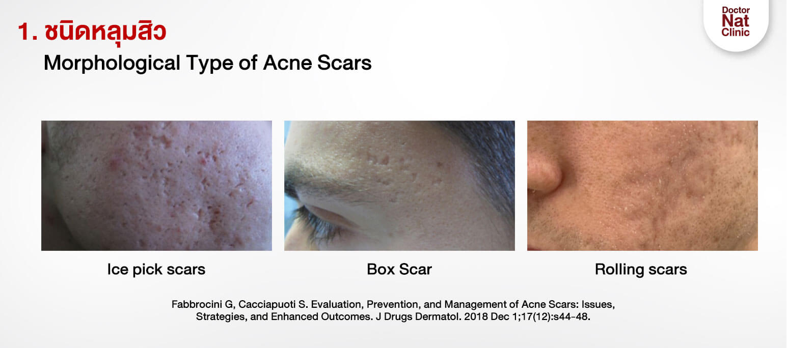 ชนิดของหลุมสิว