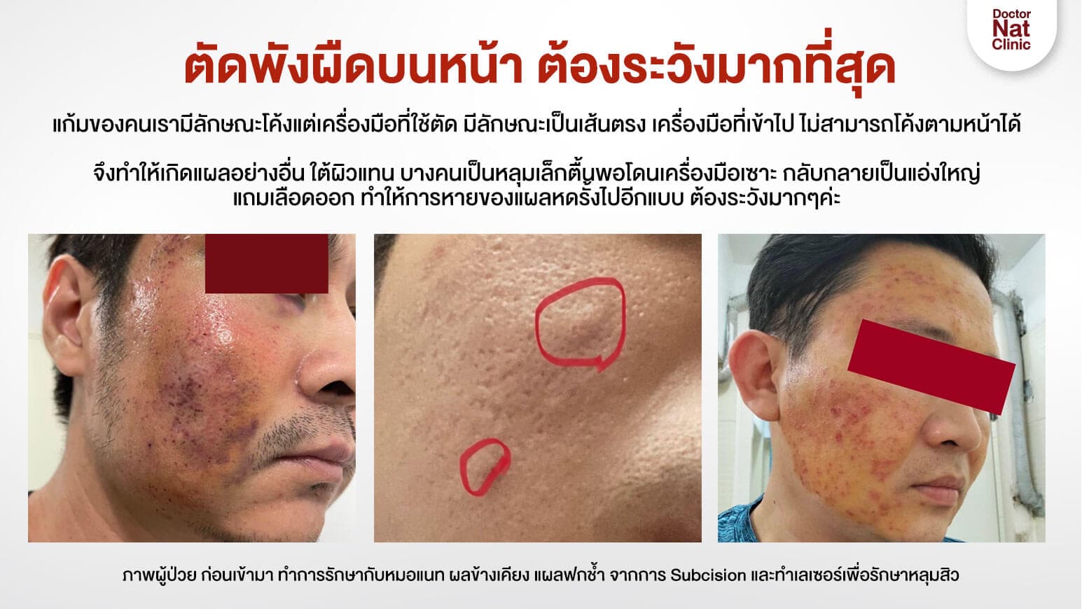 ตัดพังผืดบนหน้า ต้องระวัง