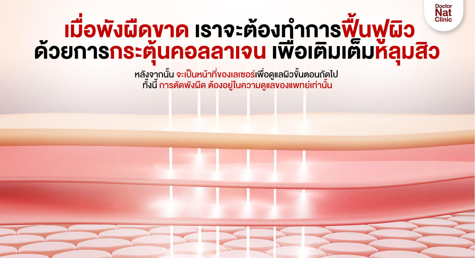 ตัดพังผืดแล้วกระตุ้นคอลลาเจน