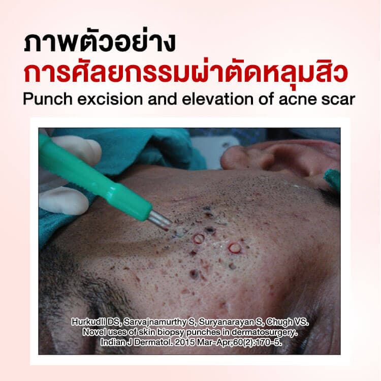 ภาพตัวอย่าง การศัลยกรรมผ่าตัดหลุมสิว