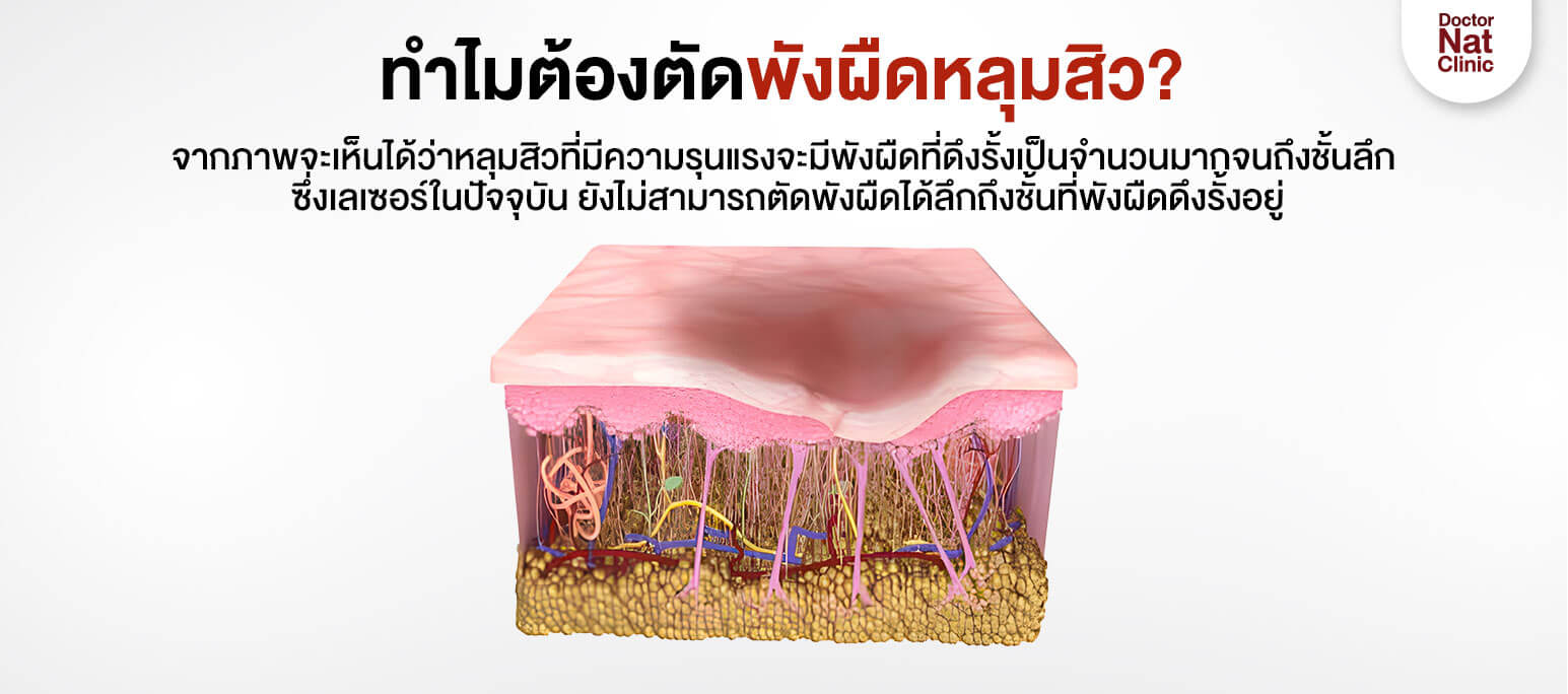 ทำไมต้องตัดพังผืดหลุมสิว