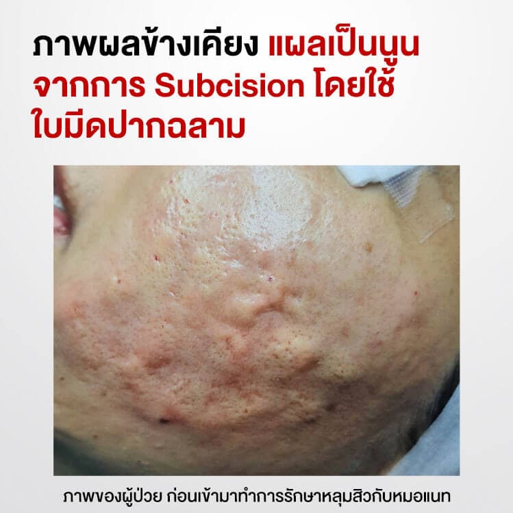 ผลข้างเคียง Subcision