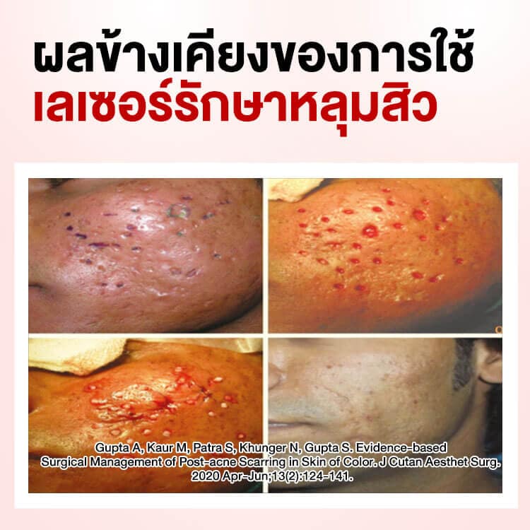 ผลข้างเคียงของการใช้เลเซอร์หลุมสิว