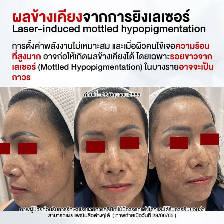 ผลข้างเคียงเลเซอร์ฝ้า