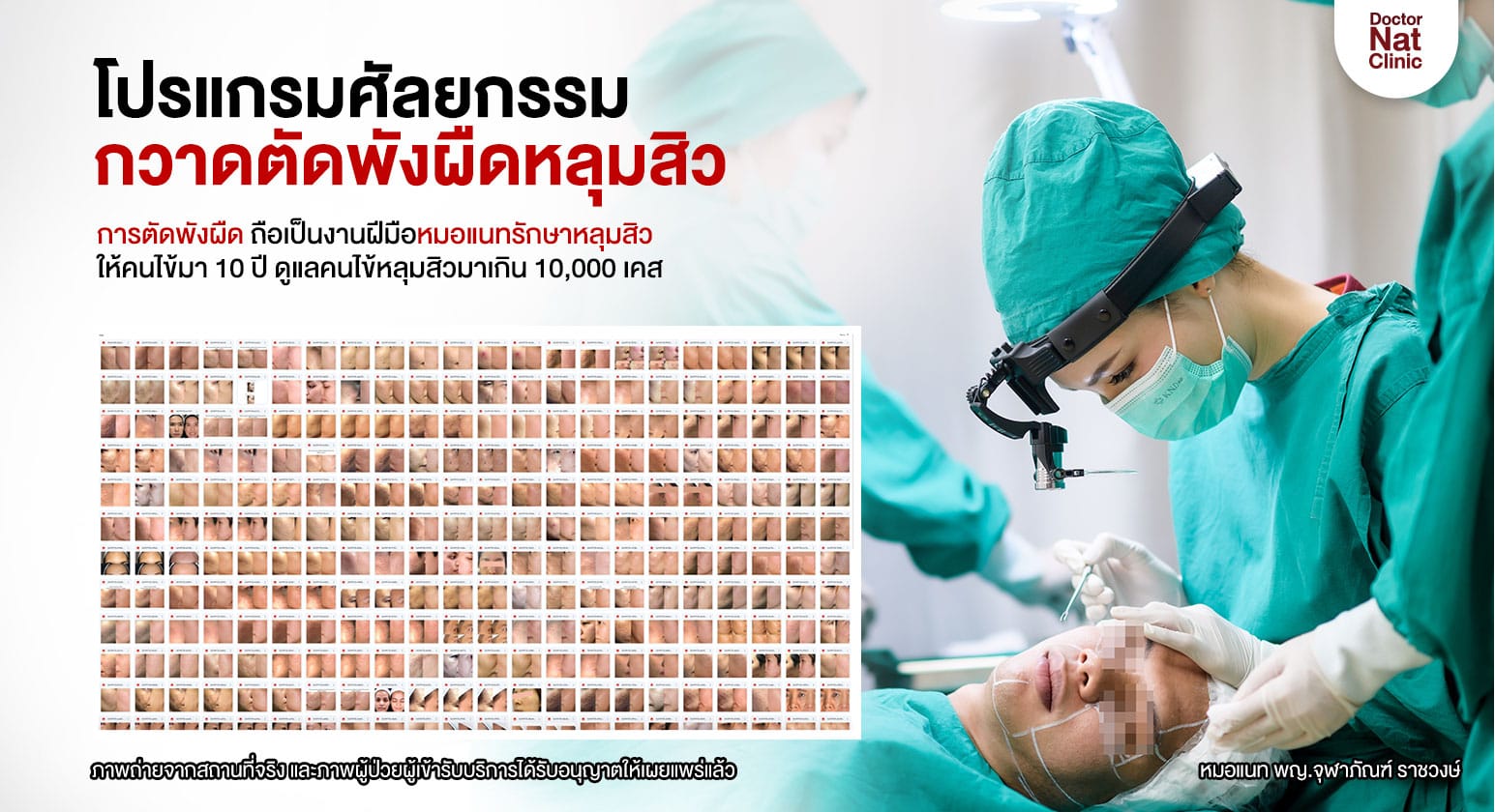 โปรแกรมศัลยกรรมกวาดตัดพังผืดหลุมสิว MASS