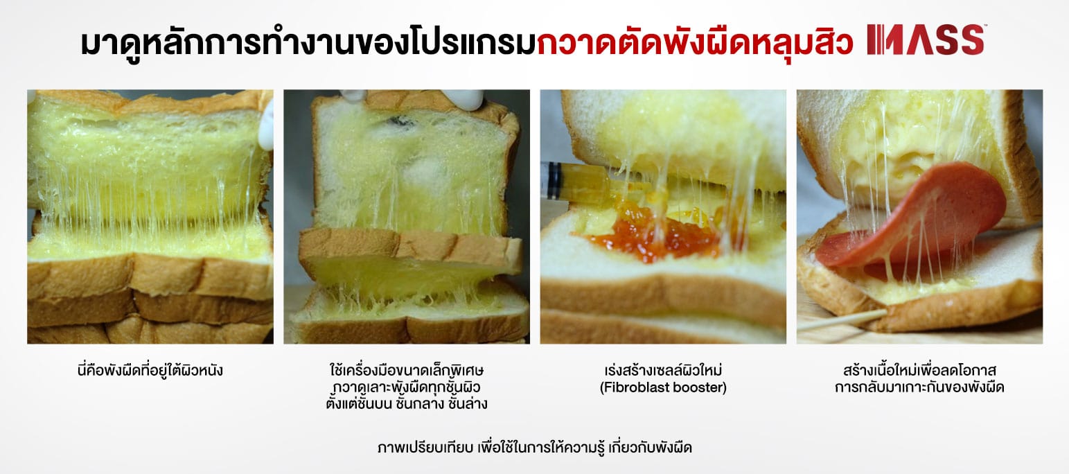 หลักการทำงานของ Mass Surgery