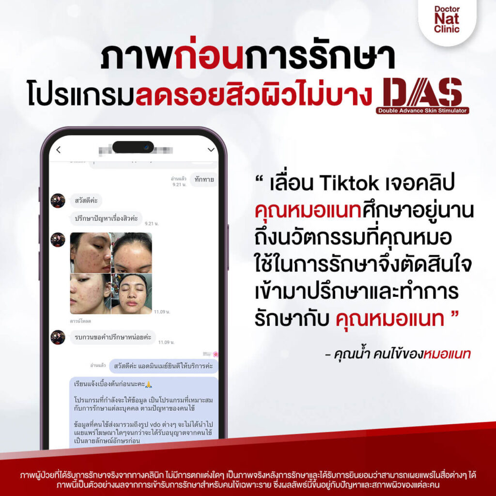 เปรียบเทียบ โปรแกรมลดรอยสิวผิวไม่บาง DAS