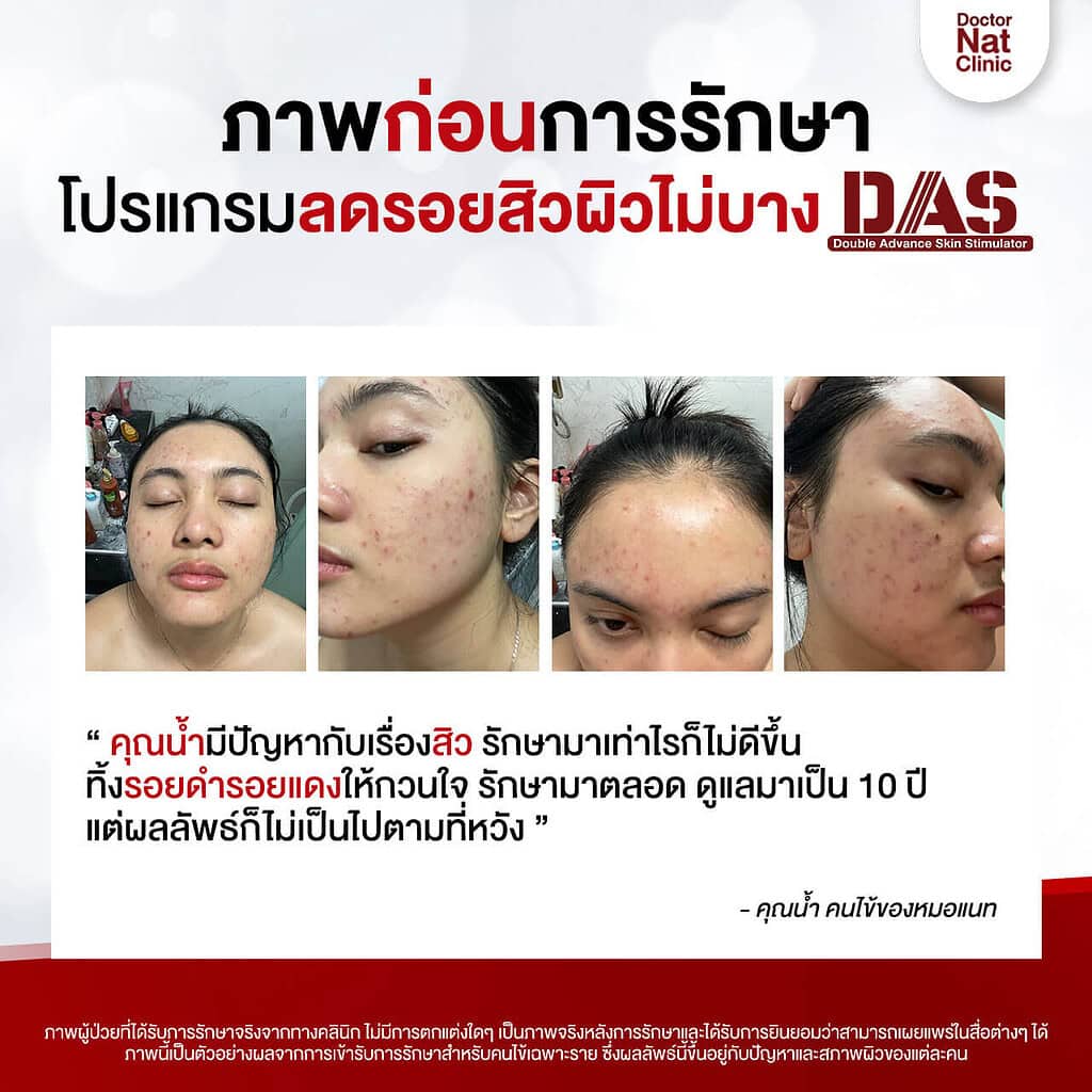 เปรียบเทียบ ลบรอยสิว หมอแนท DAS