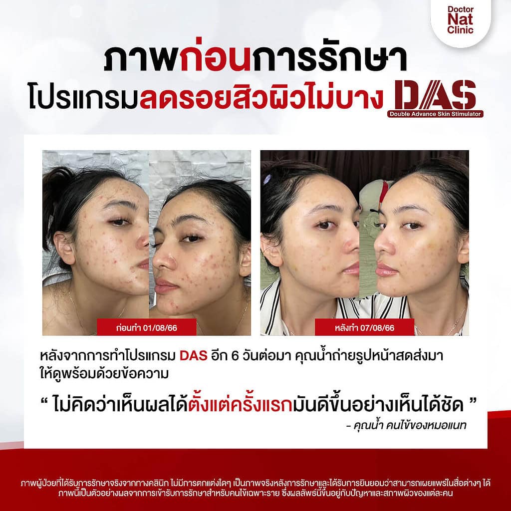 เปรียบเทียบ ลบรอยสิว หมอแนท DAS
