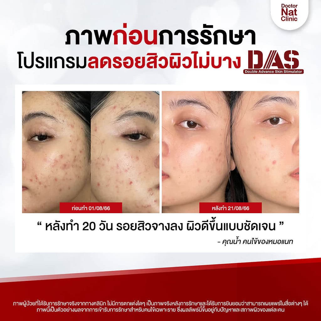 เปรียบเทียบ ลบรอยสิว หมอแนท DAS