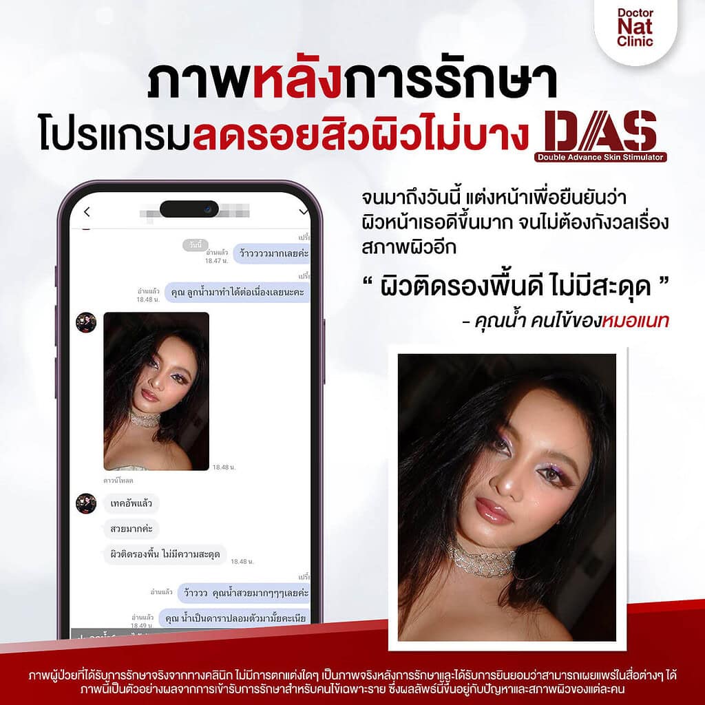 เปรียบเทียบ ลบรอยสิว หมอแนท DAS