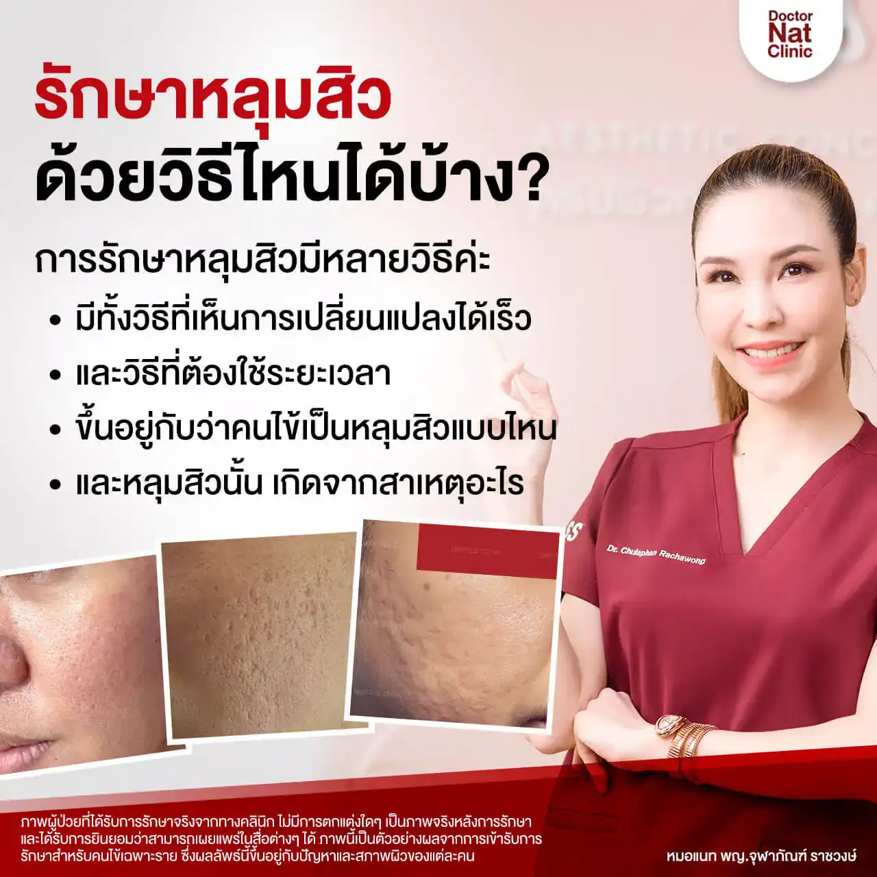หลุมสิวมีกี่แบบ หมอแนท