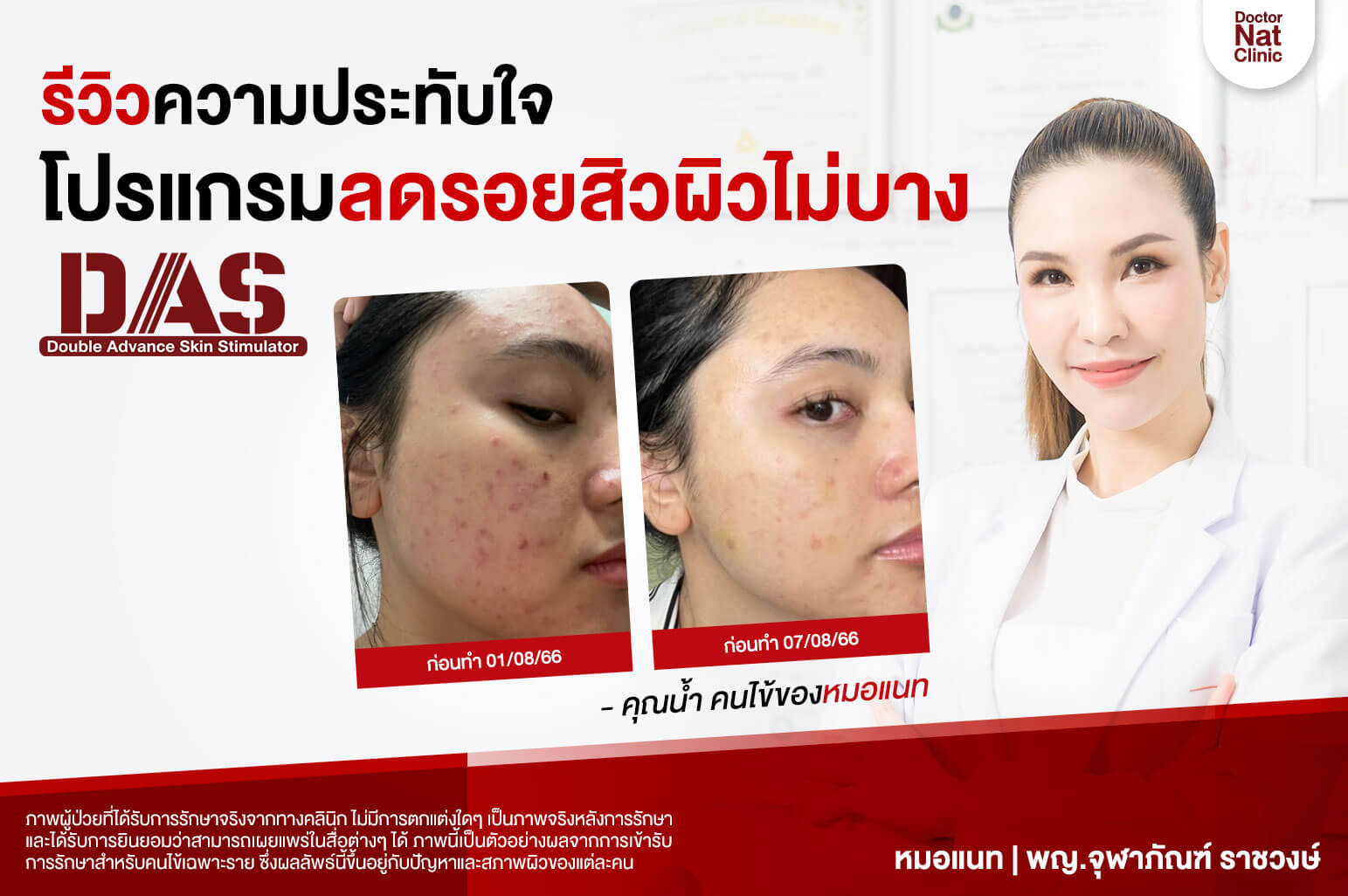 รีวิว DAS ลบรอยสิว