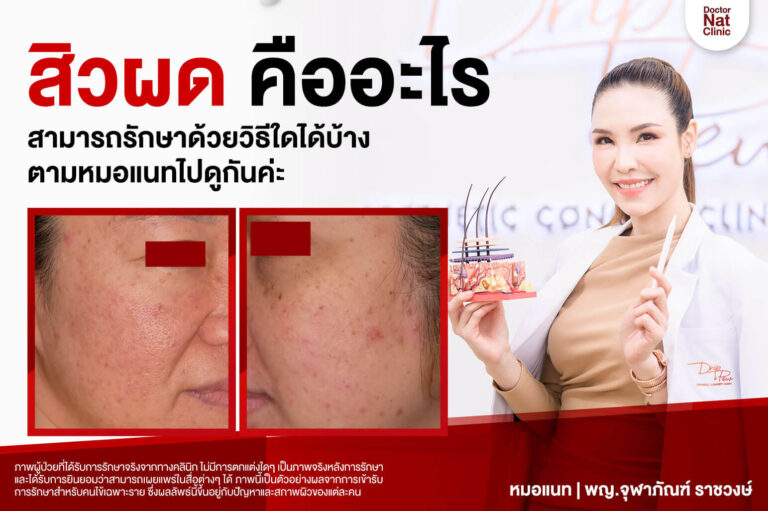 สิวผด คืออะไร? สามารถรักษาด้วยวิธีใดได้บ้าง