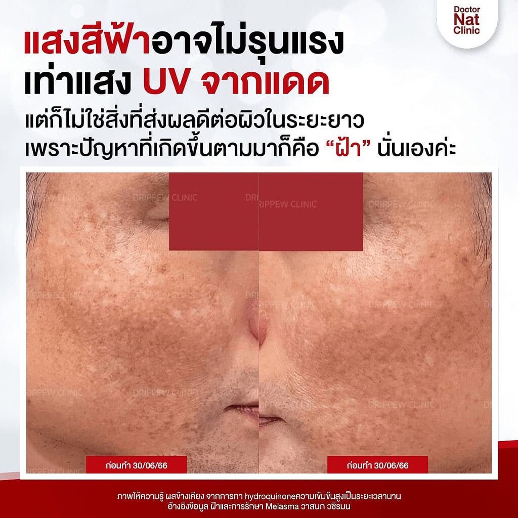 ฝ้า หมอแนท