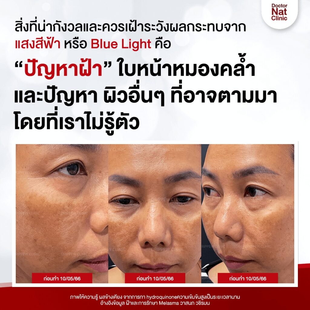 ฝ้า จาก แสงสีฟ้า