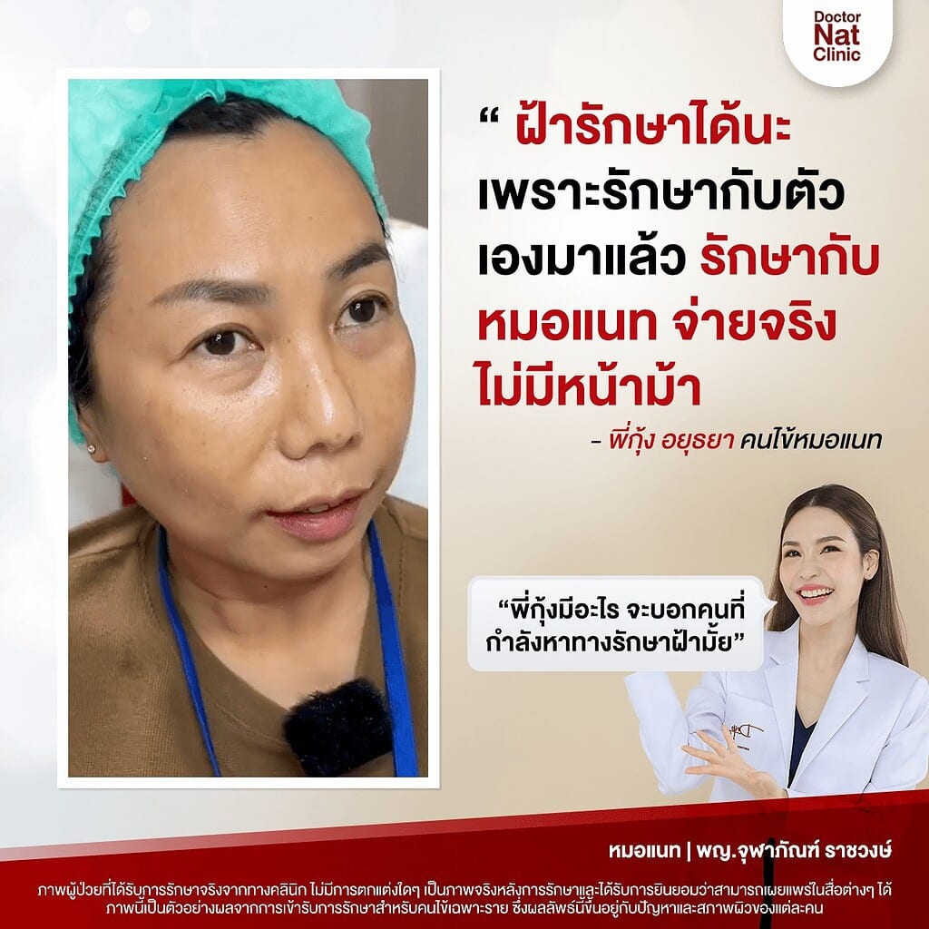 ฝ้า หมอแนท