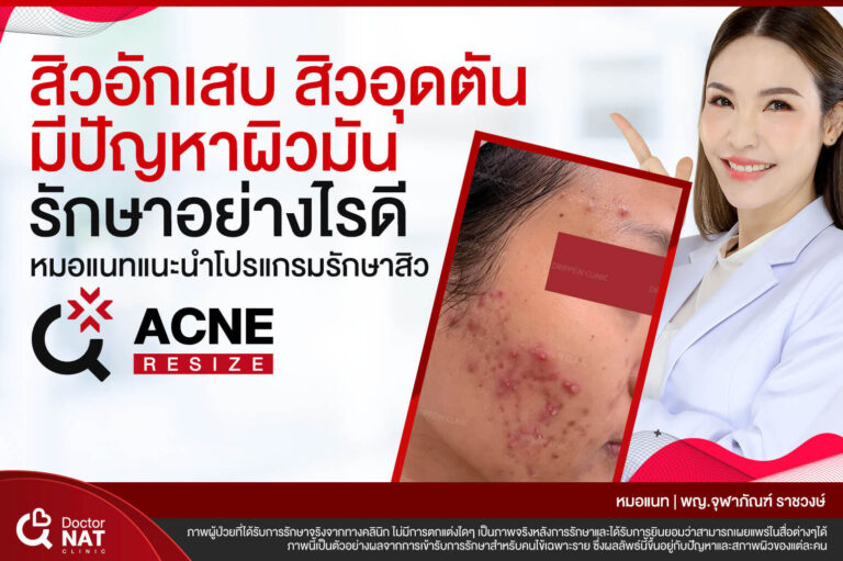 สิวอักเสบ สิวอุดตัน ผิวมัน หมอแนท