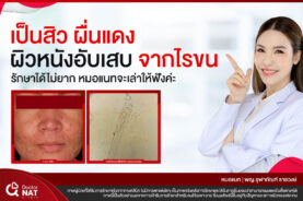หมอแนท สิว ผื่นแดง ผิวหนังอับเสบ จากไรขน รักษาได้ ไม่ยากค่ะ
