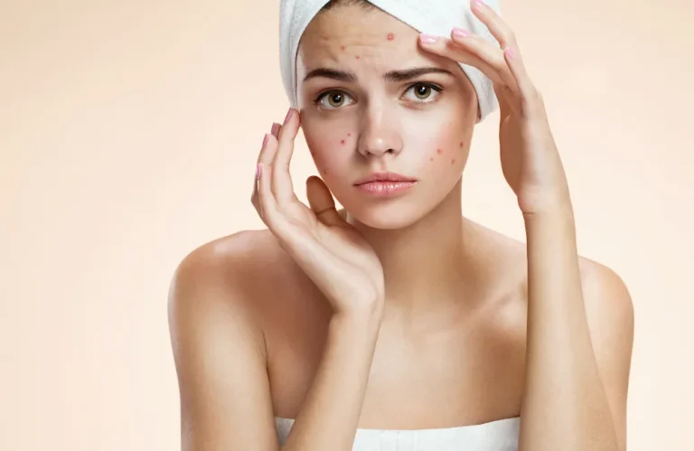 10 วิธีรักษาสิว ลดสิวได้ดี มีอะไรบ้าง