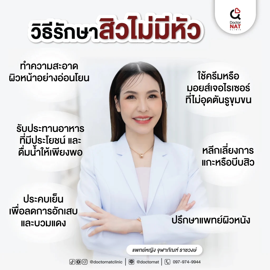 วิธีรักษาสิวไม่มีหัว