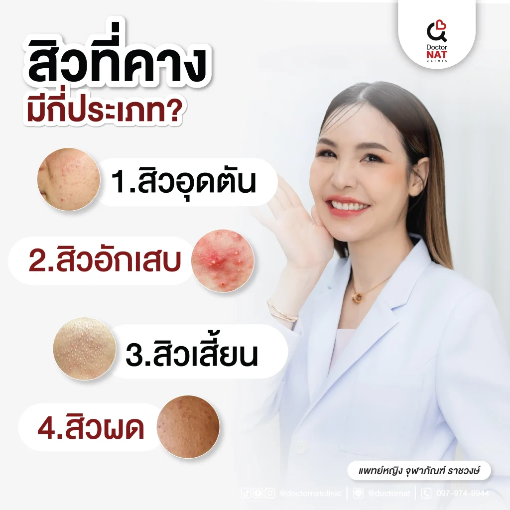 สิวที่คางมีกี่ประเภท