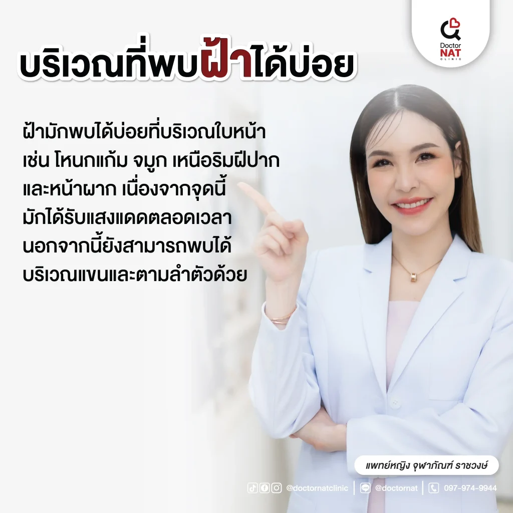 บริเวณที่พบฝ้าได้บ่อย