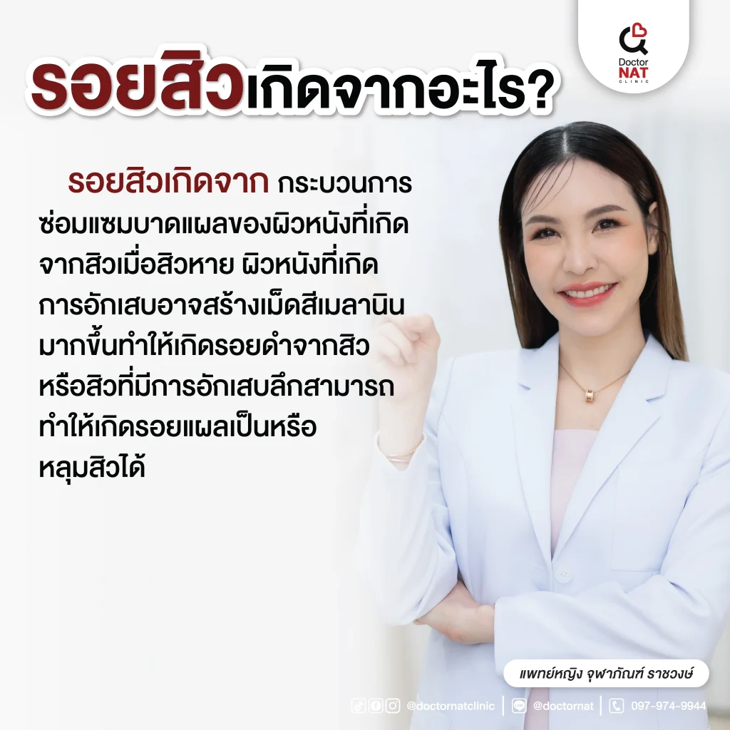 รอยสิวเกิดจากอะไร