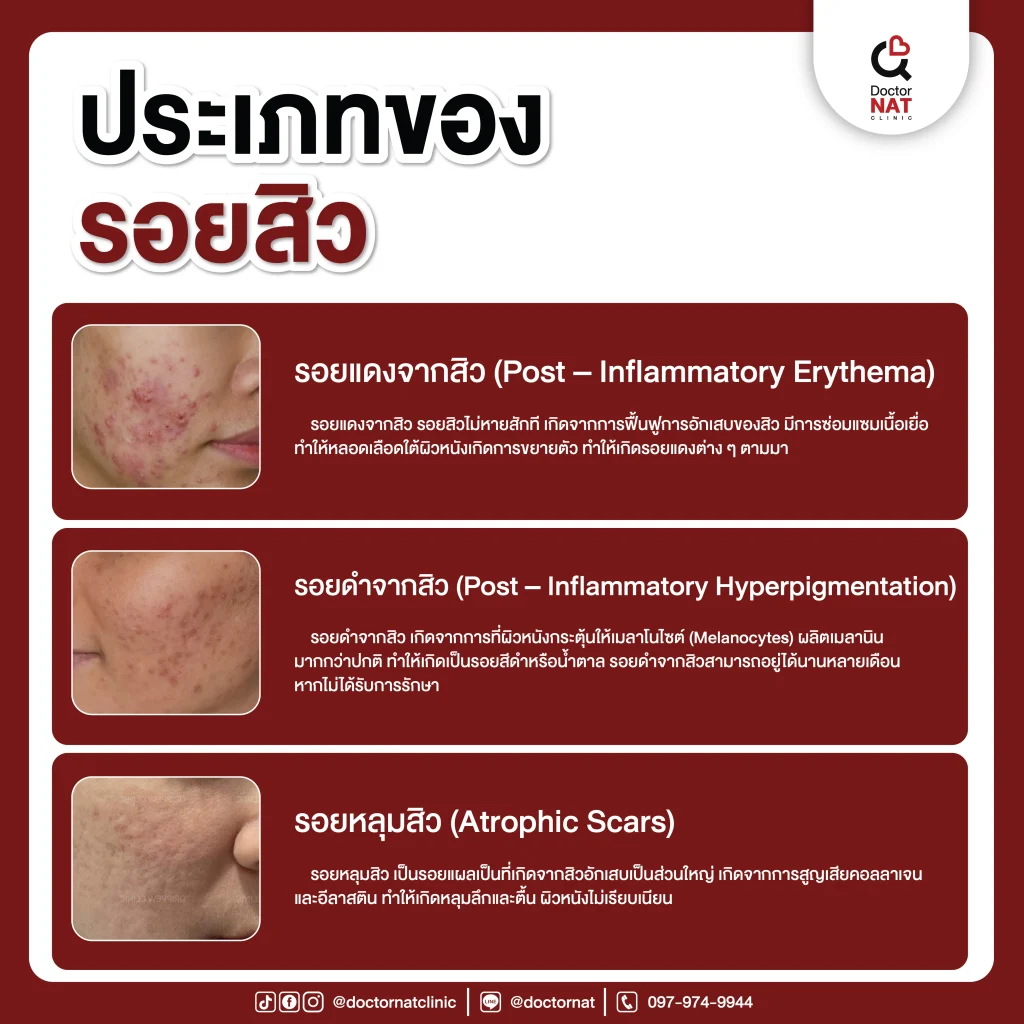 ประเภทของรอยสิว