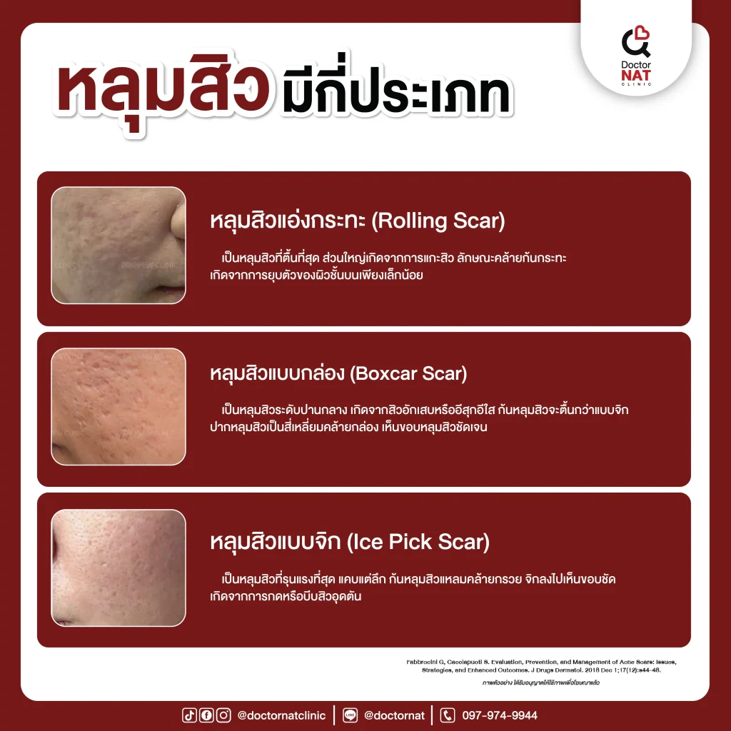 หลุมสิวมีกี่ประเภท