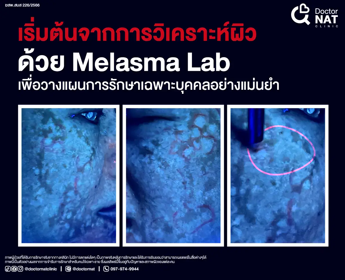เริ่มต้นจากการวิเคราะห์ผิวด้วย Melasma Lab
เพื่อวางแผนการรักษาฝ้าเฉพาะบุคคล