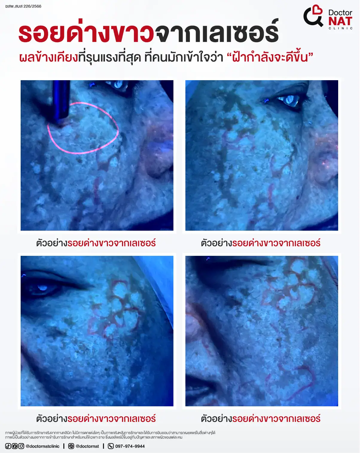 รอยด่างขาวจากเลเซอร์ คืออะไร เกิดขึ้นได้อย่างไร