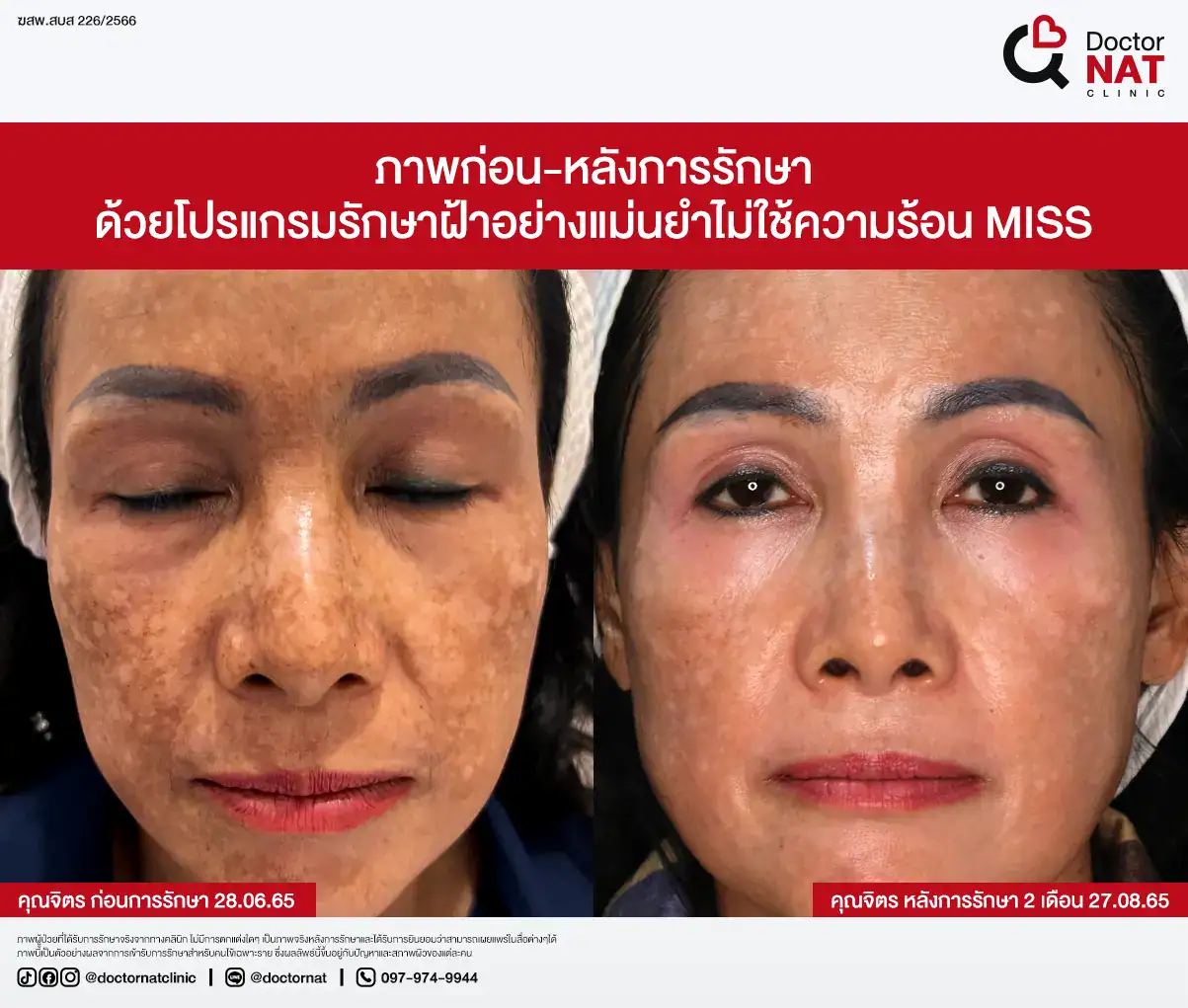 ภาพก่อน-หลังการรักษาฝ้า
ด้วยโปรแกรมรักษาฝ้าอย่างแม่นยำไม่ใช้ความร้อน MISS Doctor NAT Clinic