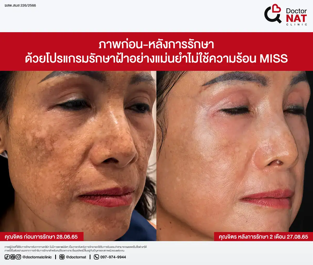ภาพก่อน-หลังการรักษาฝ้า
ด้วยโปรแกรมรักษาฝ้าอย่างแม่นยำไม่ใช้ความร้อน MISS Doctor NAT Clinic