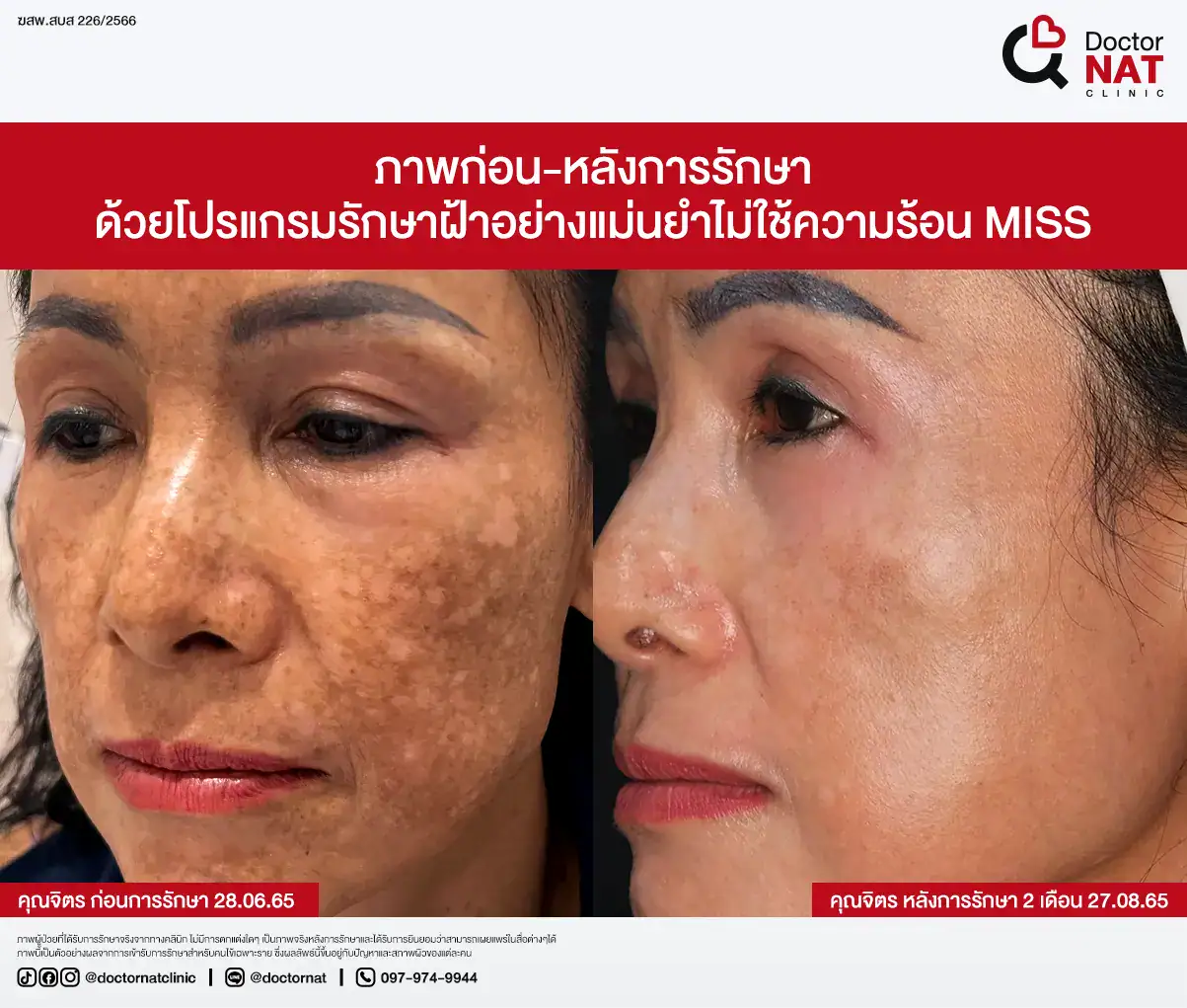 ภาพก่อน-หลังการรักษาฝ้า
ด้วยโปรแกรมรักษาฝ้าอย่างแม่นยำไม่ใช้ความร้อน MISS Doctor NAT Clinic