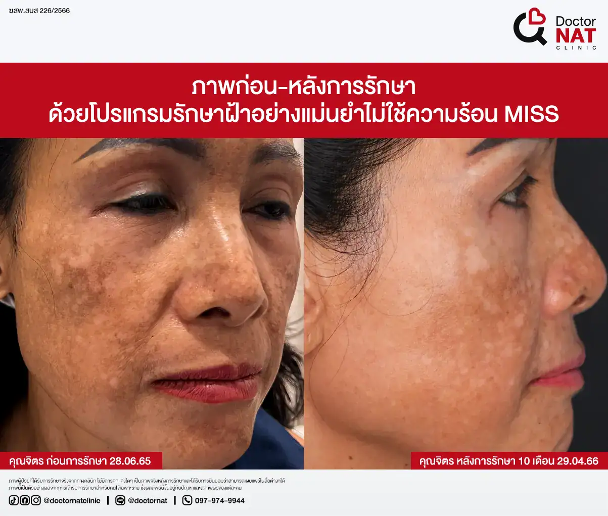 ภาพก่อน-หลังการรักษาฝ้า
ด้วยโปรแกรมรักษาฝ้าอย่างแม่นยำไม่ใช้ความร้อน MISS Doctor NAT Clinic