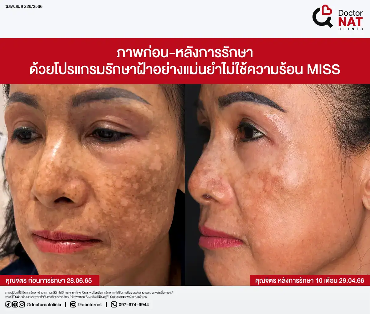 ภาพก่อน-หลังการรักษาฝ้า
ด้วยโปรแกรมรักษาฝ้าอย่างแม่นยำไม่ใช้ความร้อน MISS Doctor NAT Clinic
