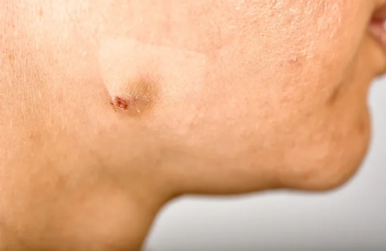 สิวเป็นไต รักษาอย่างไรให้หาย