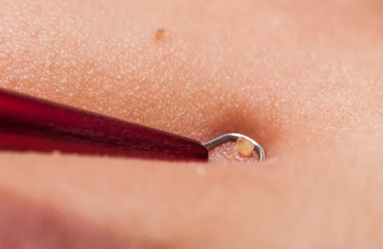 กดสิวดีไหม มีข้อดีข้อเสียอะไรบ้าง