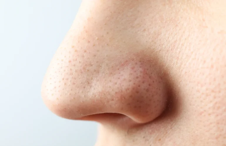 รักษาปัญหาสิวเสี้ยนอย่างไรดี