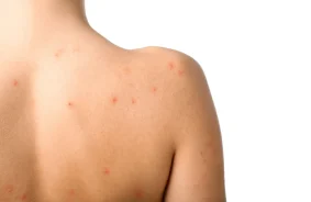 สิวที่หลัง (Back Acne) เกิดจากอะไร รักษายังไง