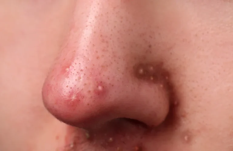 สิวขึ้นที่จมูกเกิดจากอะไร รักษาอย่างไรดี