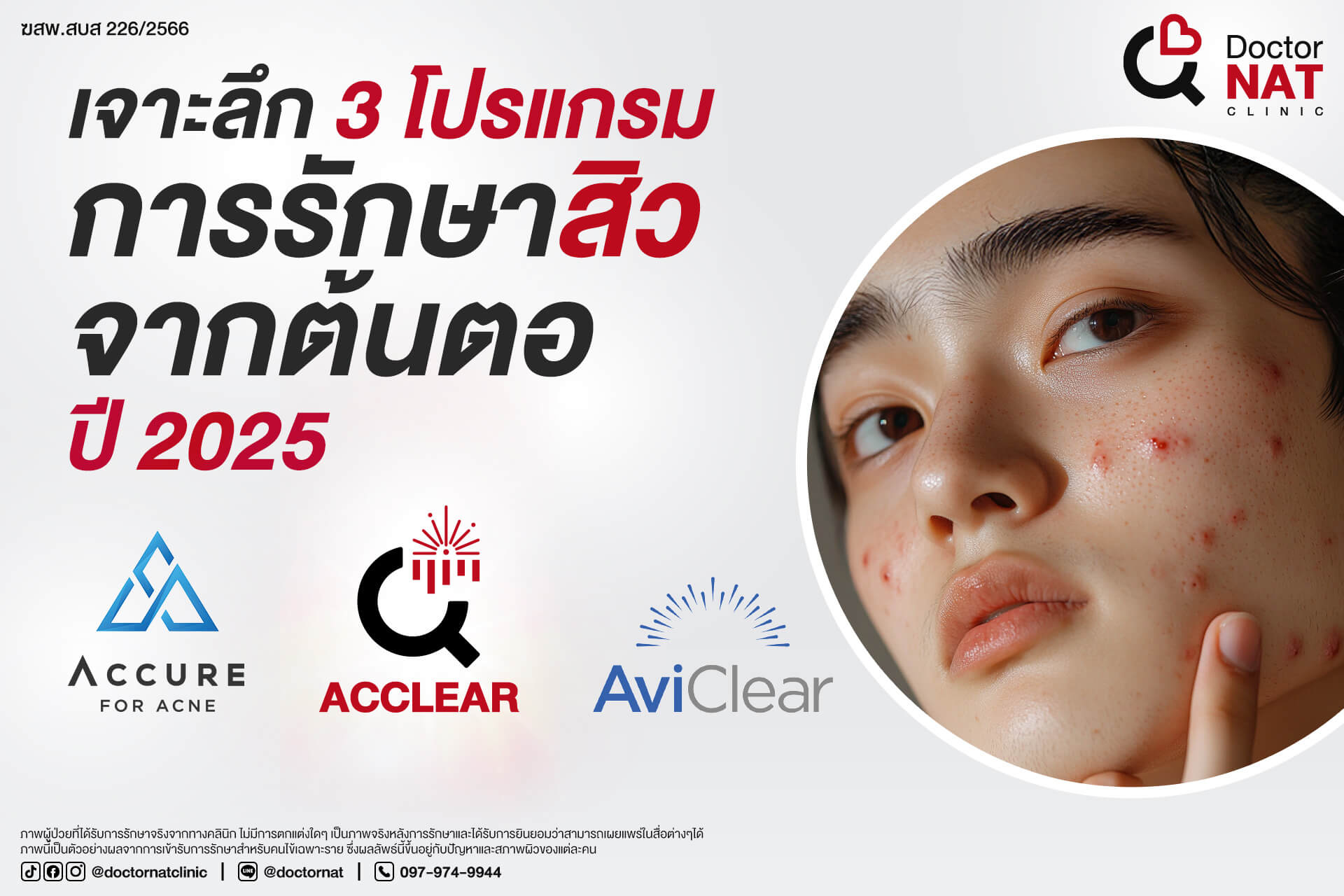 เจาะลึก 3 โปรแกรม การรักษาสิวจากต้นตอ ปี 2025