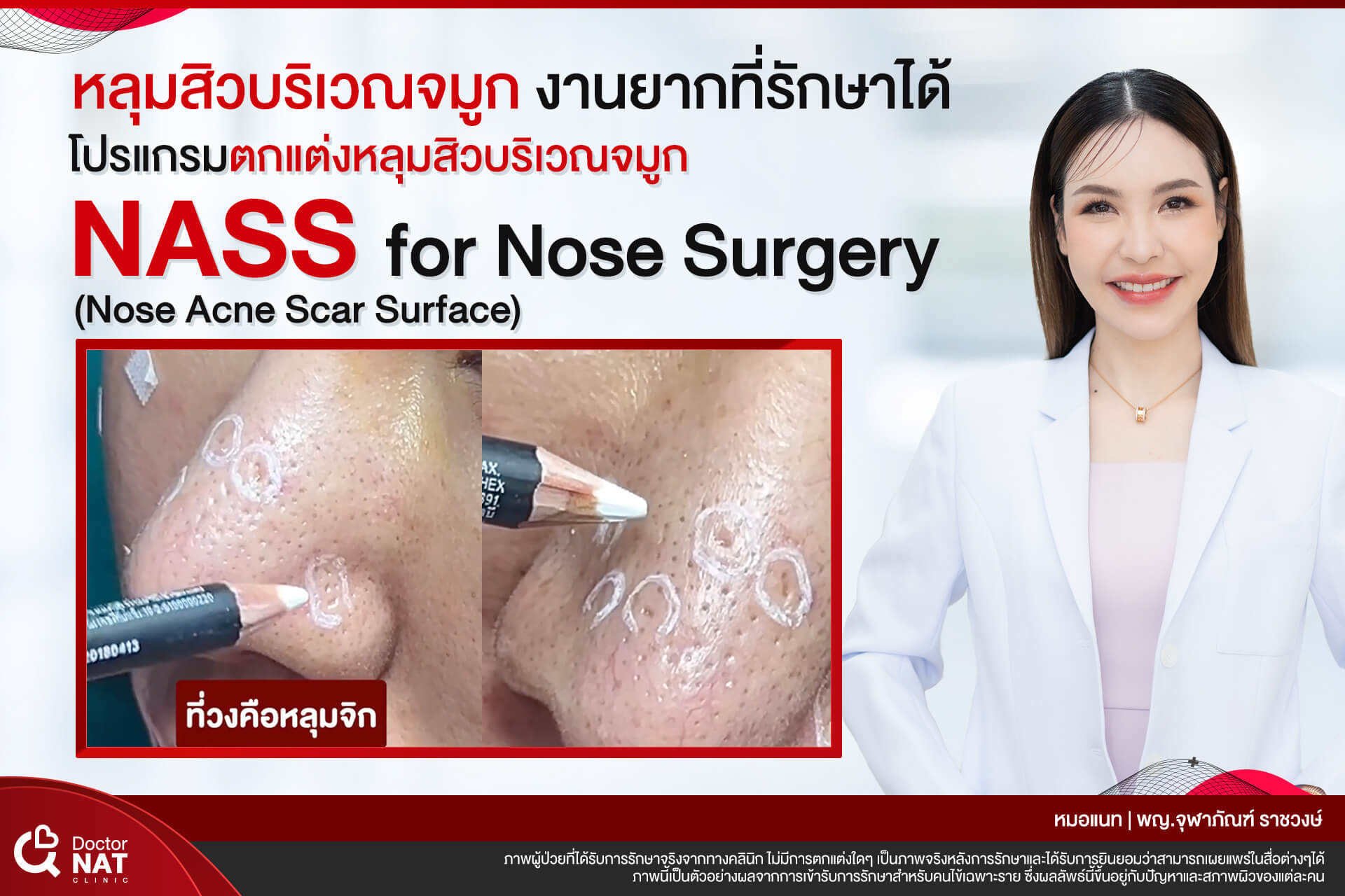 หลุมสิวบริเวณจมูก งานยาก ที่รักษาได้ หมอแนท Doctor NAT Clinic