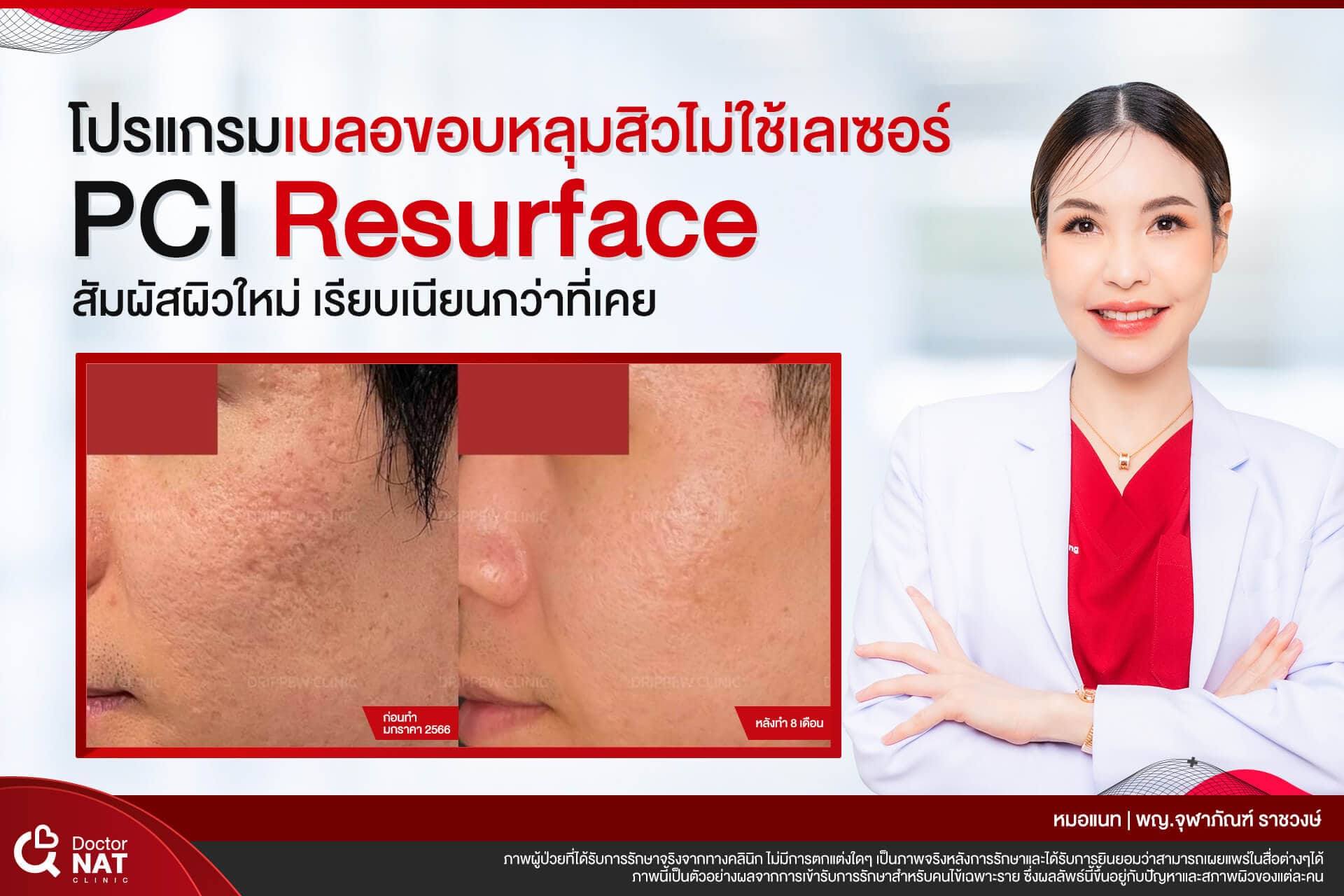 โปรแกรมเบลอขอบหลุมสิว ไม่ใช้เลเซอร์ PCI Resurface