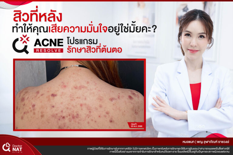 สิวที่หลัง ทำให้เสียความมั่นใจ