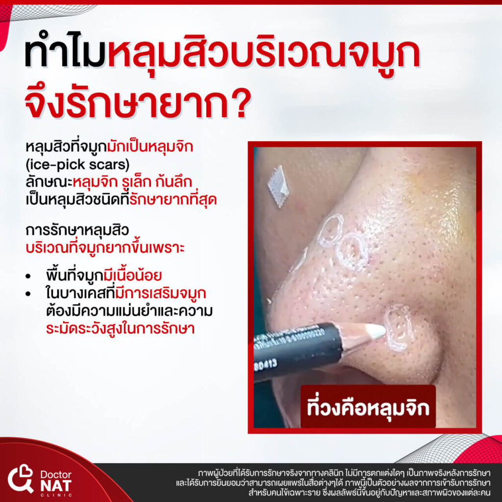 หลุมสิวบริเวณจมูก งานยาก ที่รักษาได้ หมอแนท Doctor NAT Clinic