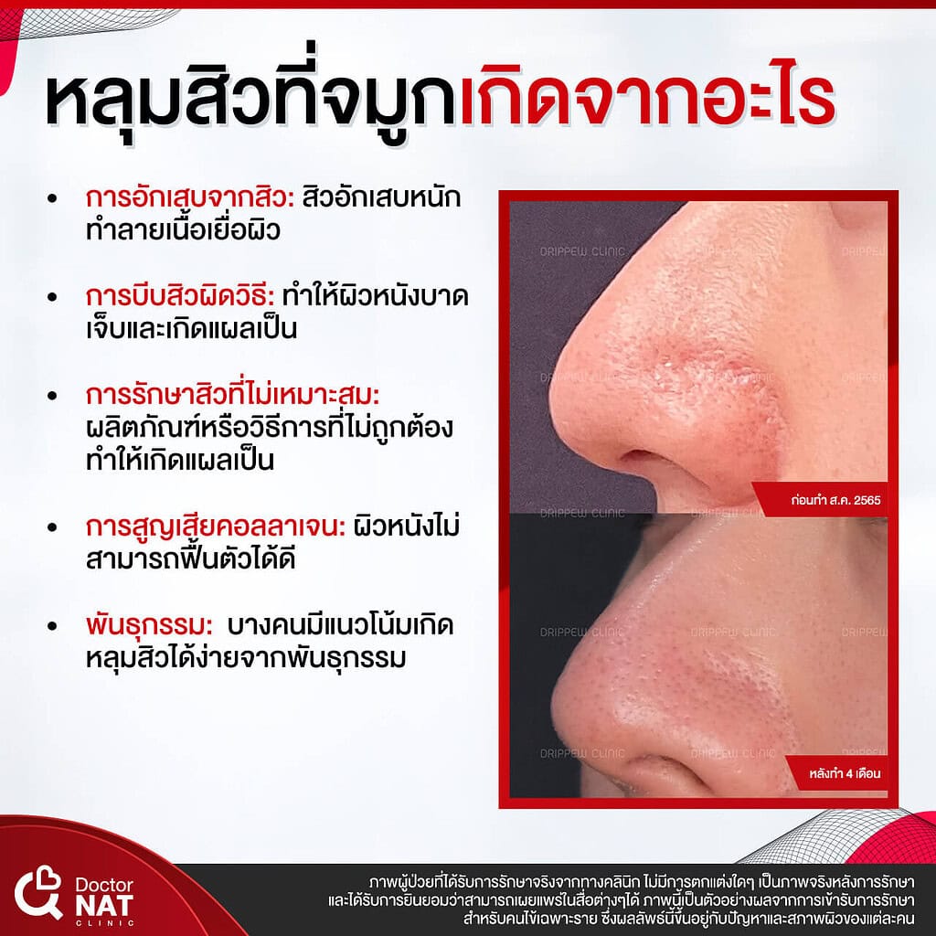 หลุมสิวบริเวณจมูก งานยาก ที่รักษาได้ หมอแนท Doctor NAT Clinic